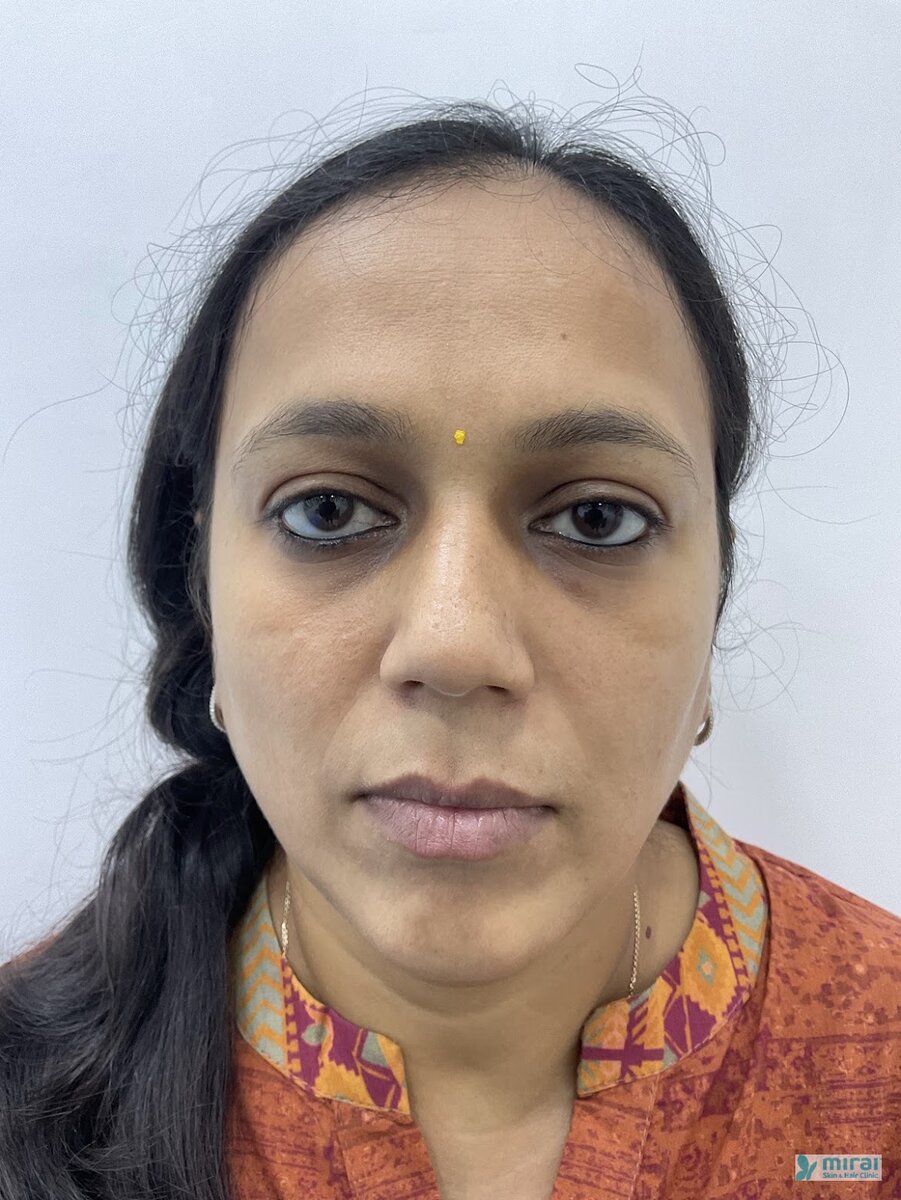 Ami Shah Before Microblading