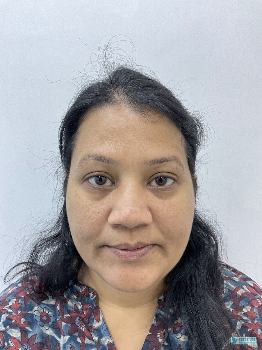 Divya Before Microblading