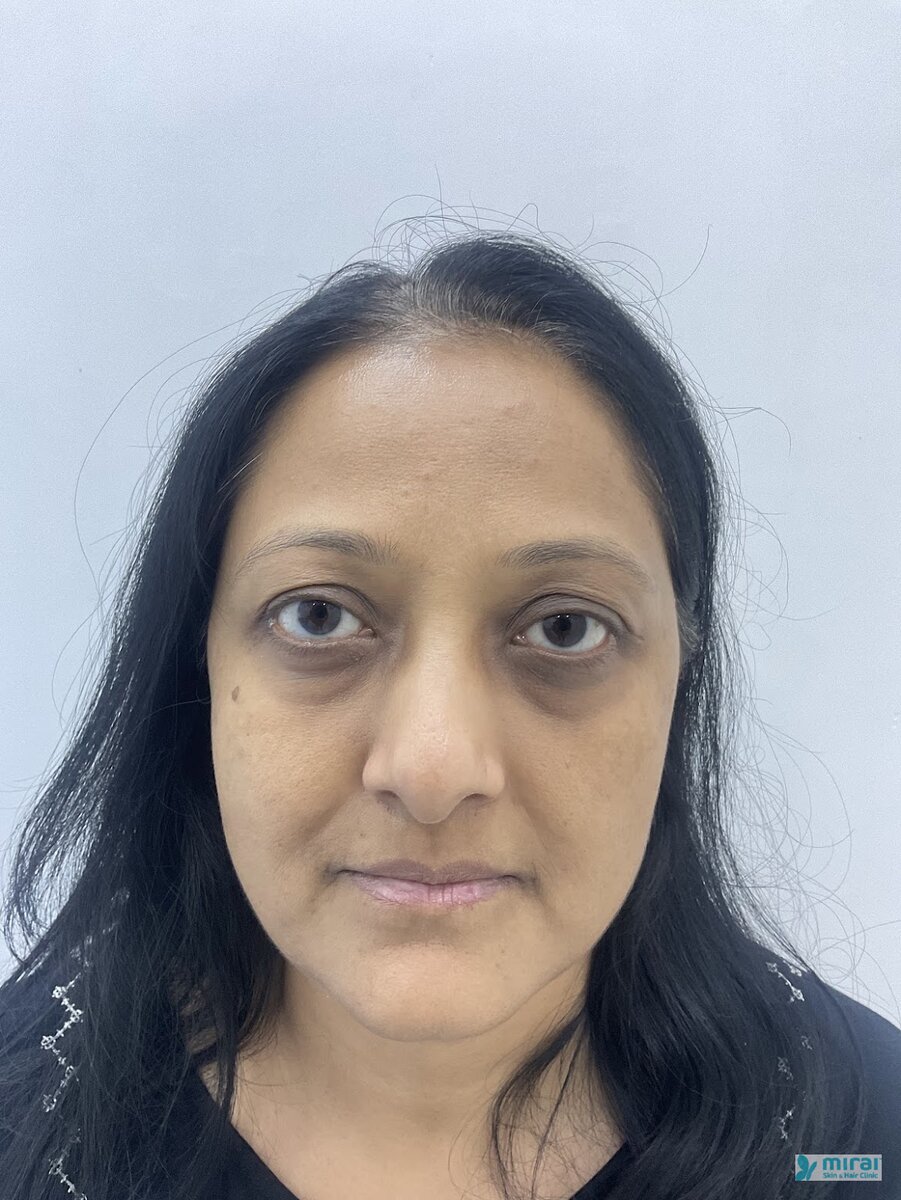 Hetal Patel Before Microblading