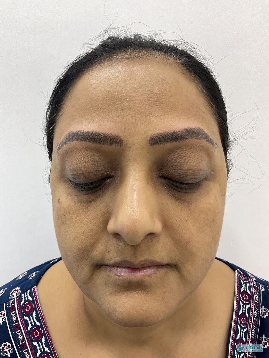 Hetal Patel After Microblading