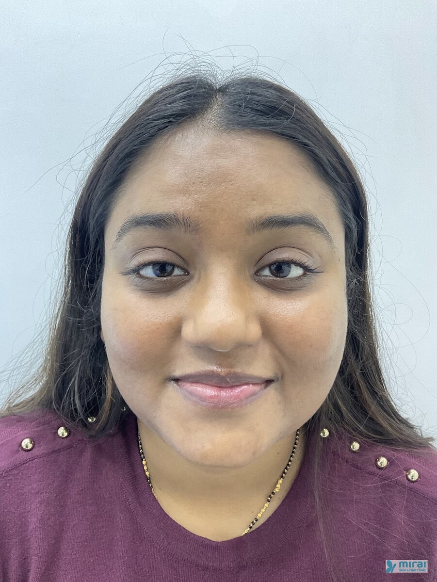 Ishita Before Microblading