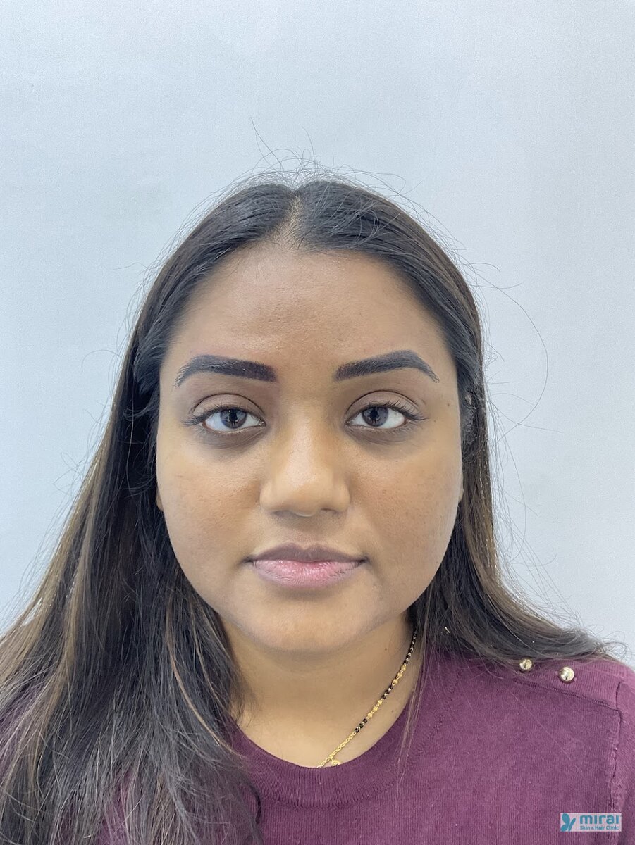 Ishita After Microblading