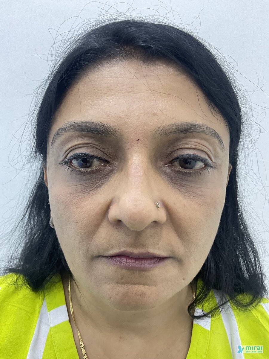 Kajal Shah Before Microblading