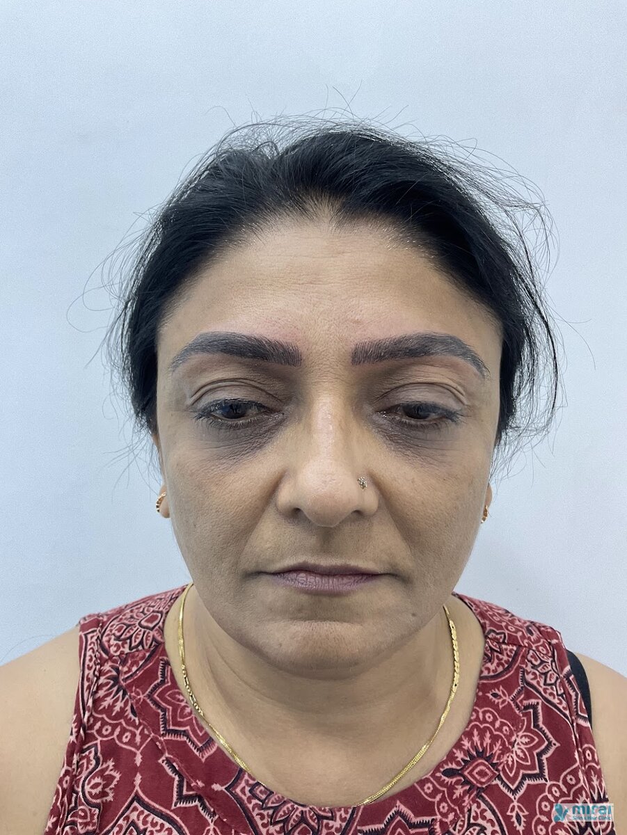 Kajal Shah After Microblading