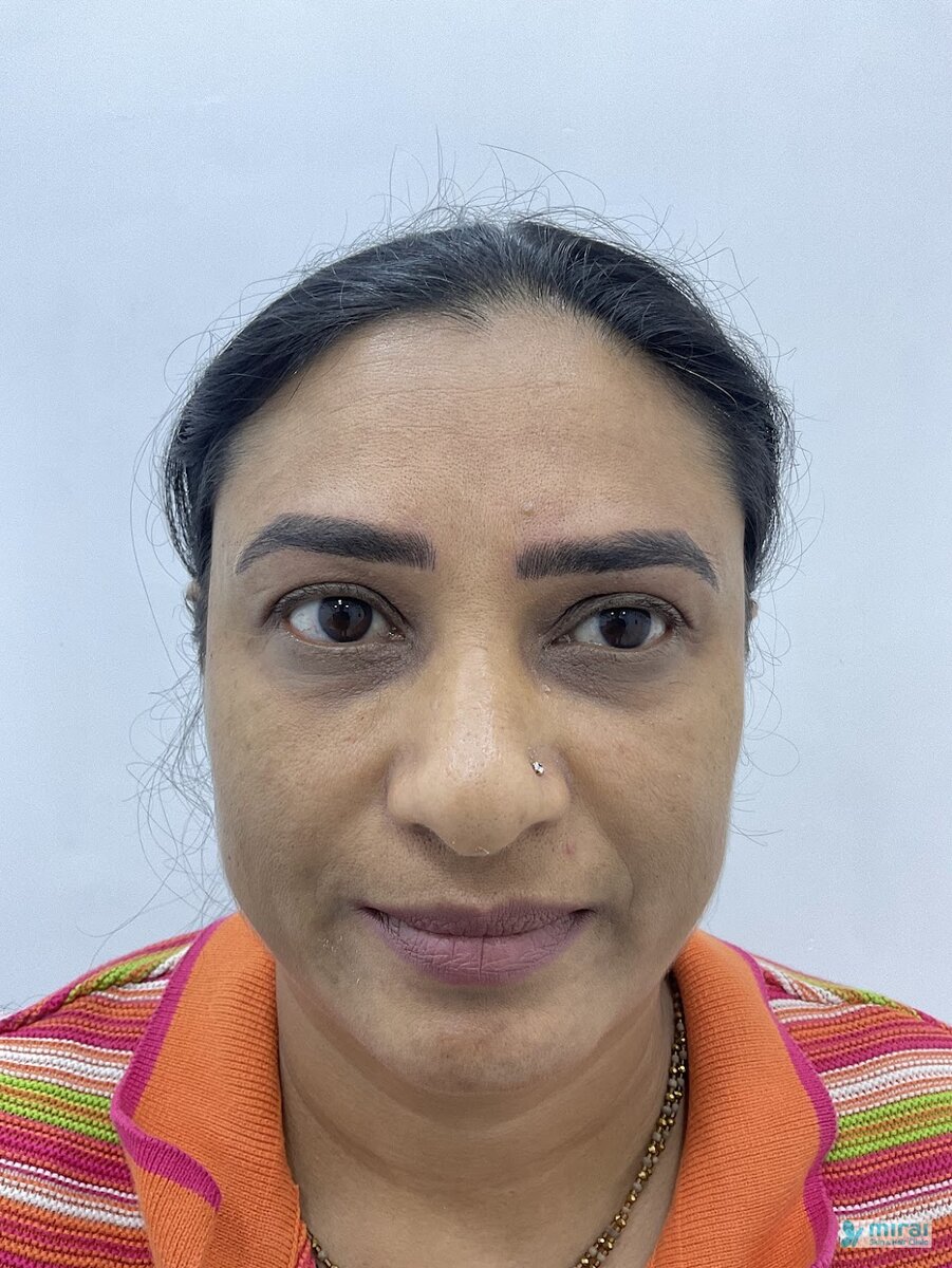 Komal Vagadiya Before Microblading