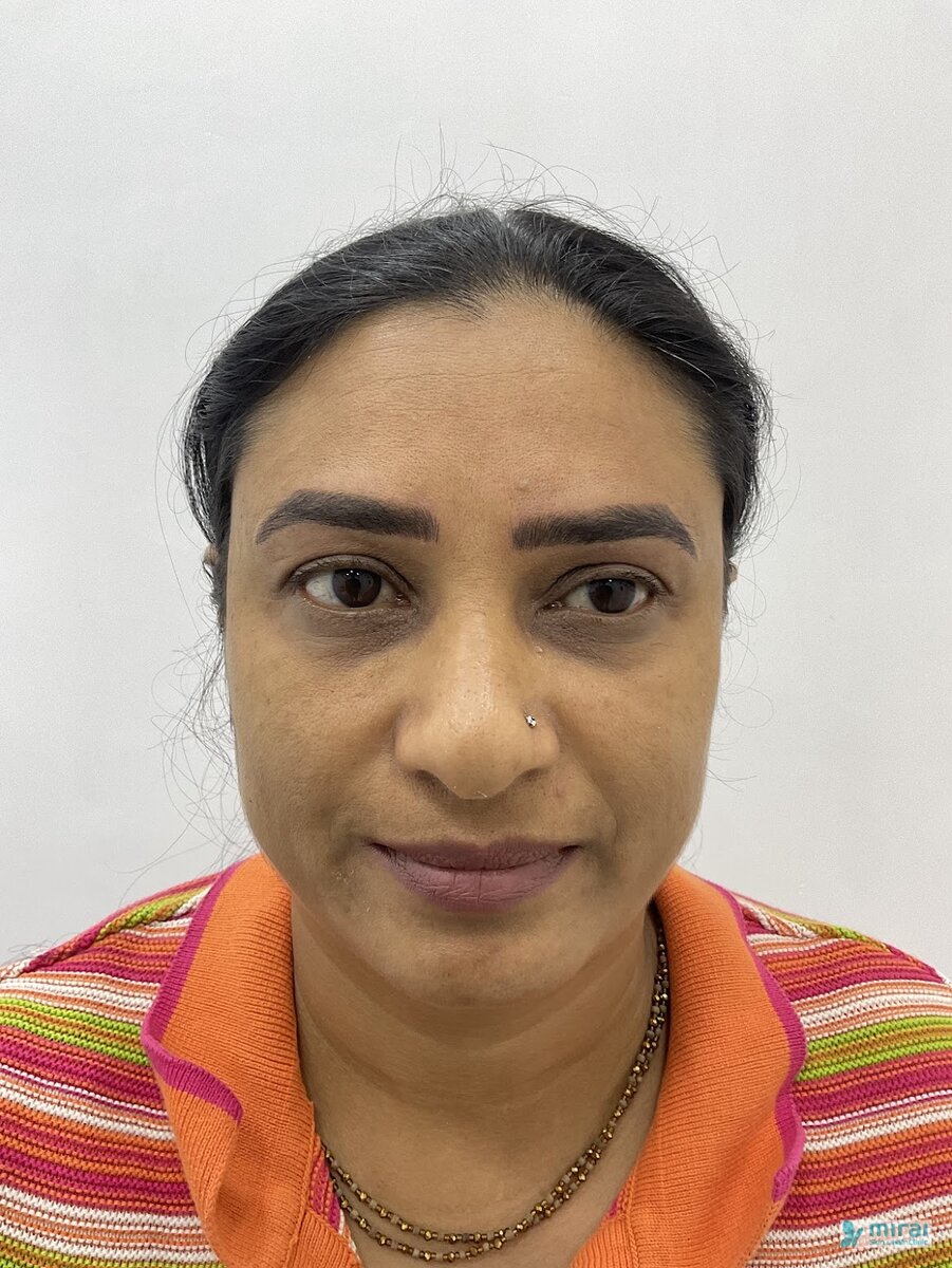 Komal Vagadiya After Microblading