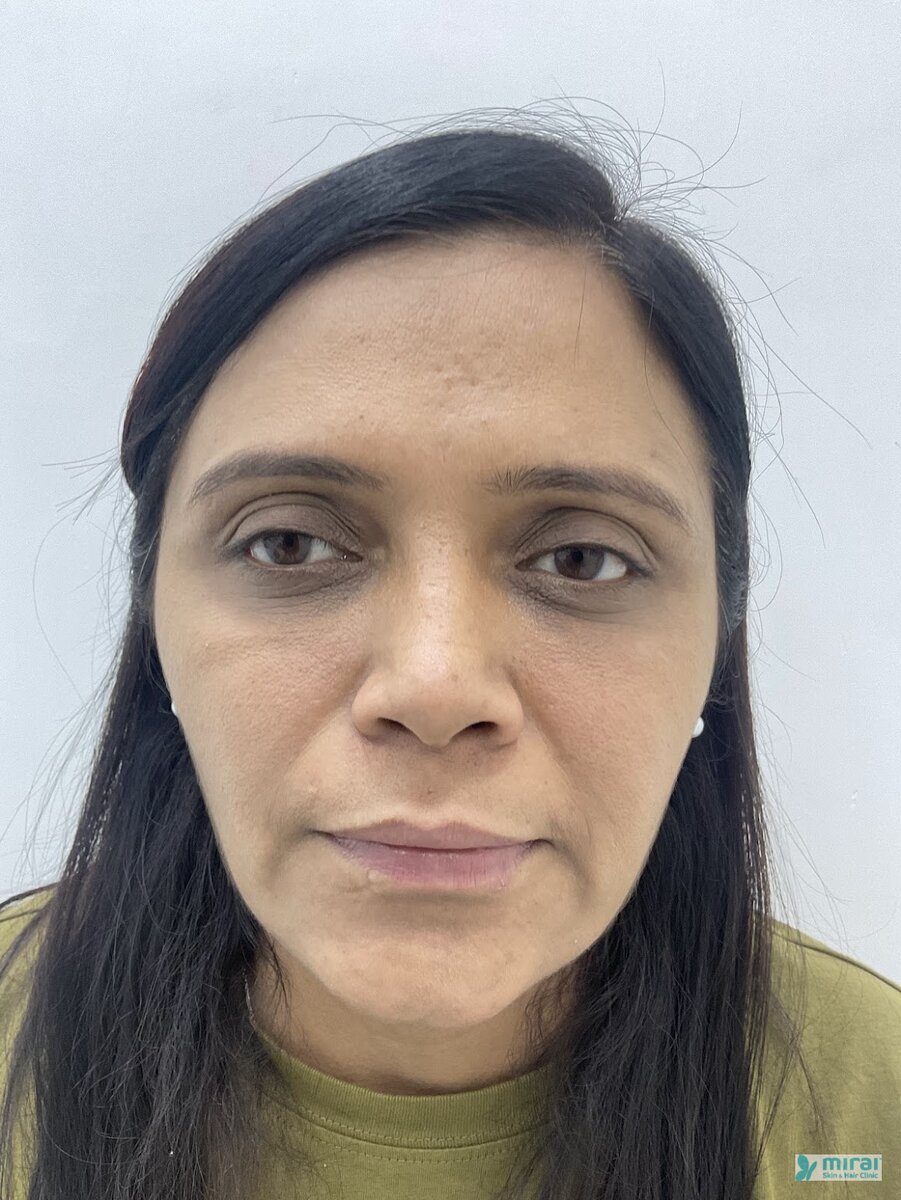 Pooja Before Microblading