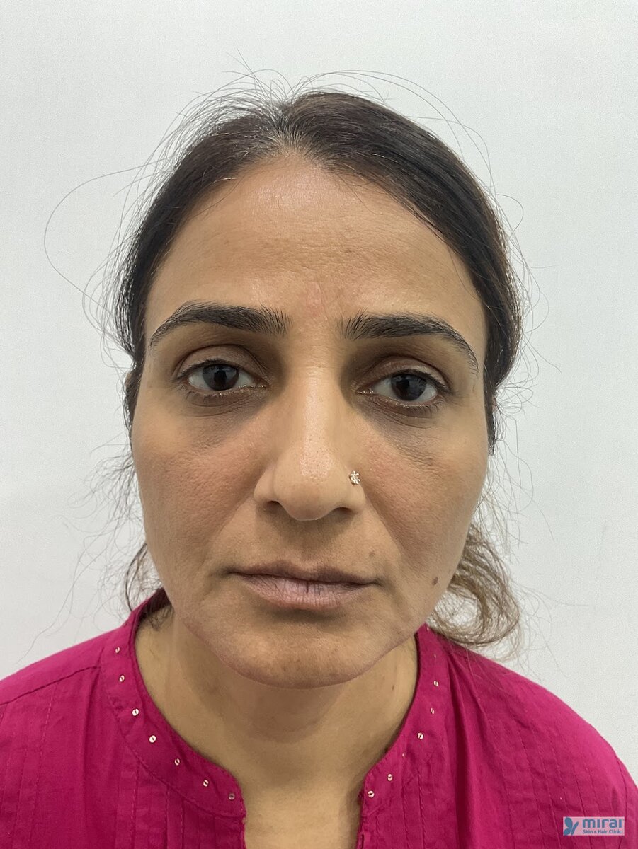 Priti Chauhan Before Microblading