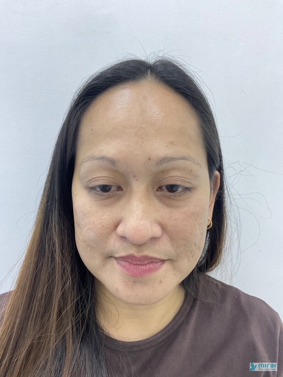 Rinalyn Before Microblading