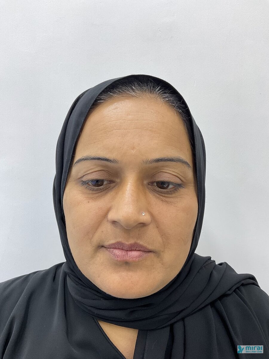 Shabanam Before Microblading