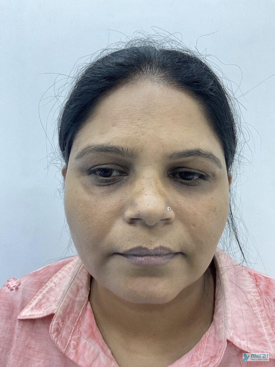 Surekha Before Microblading