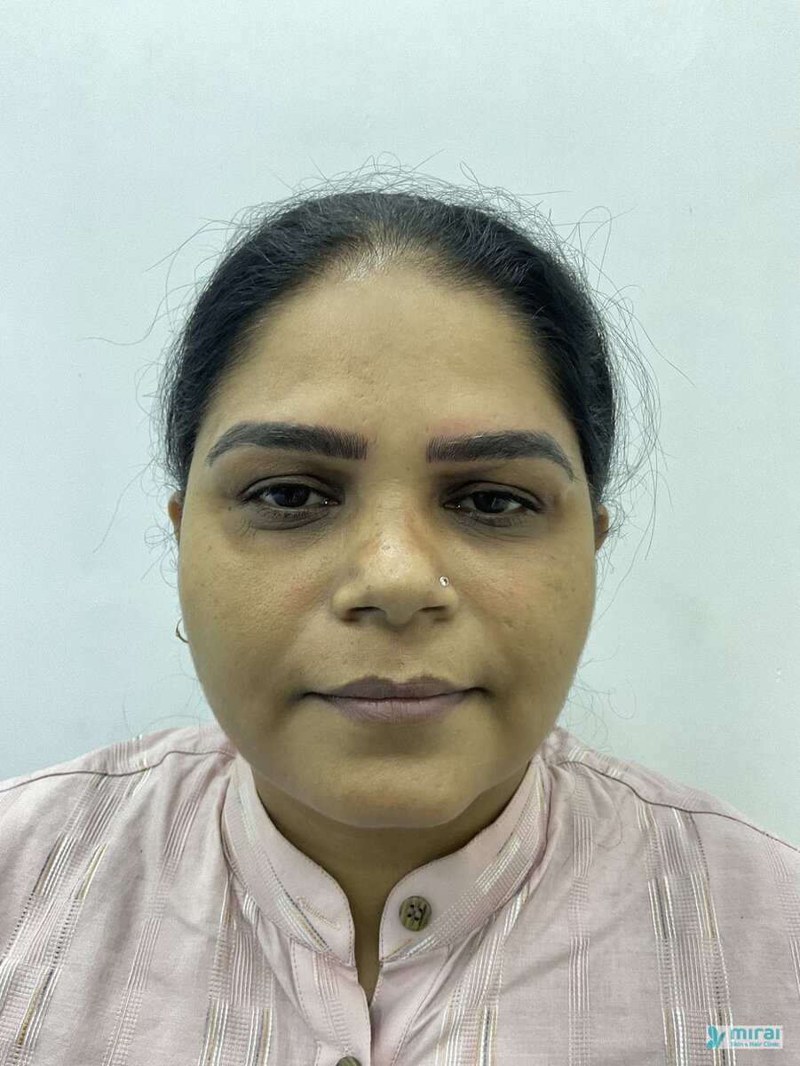 Surekha After Microblading