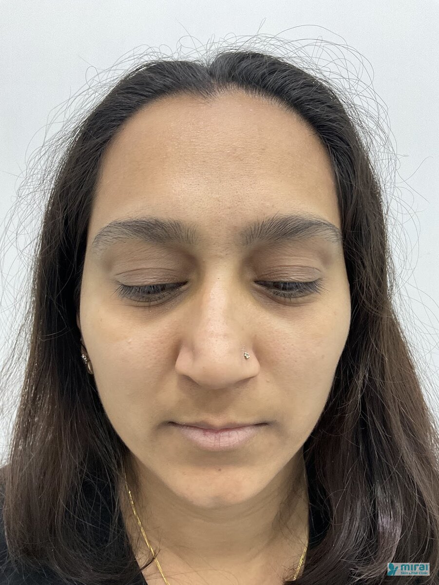 Tanvi Before Microblading