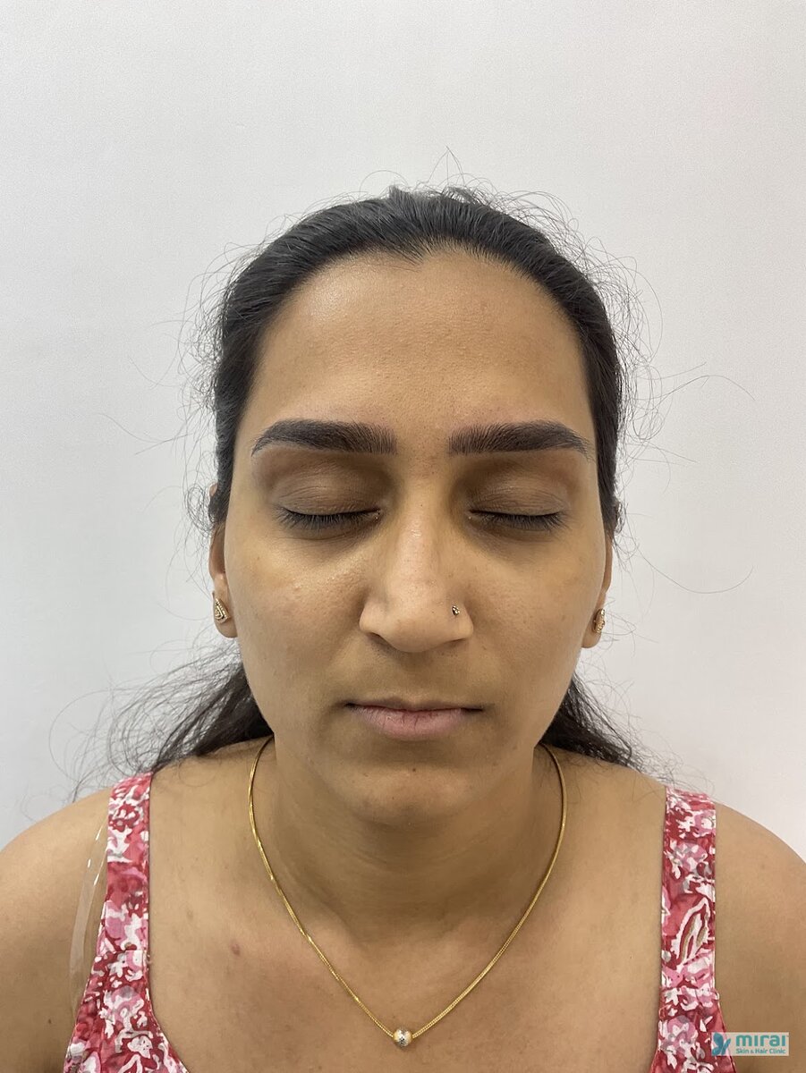 Tanvi After Microblading
